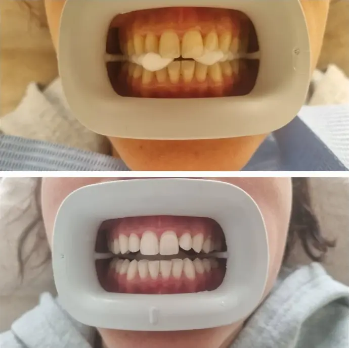 Avant Après - Blanchiment dentaire
